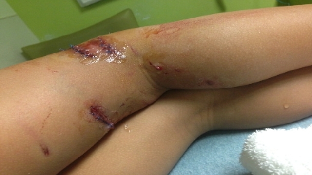 dog bite buttocks dog bite buttocks