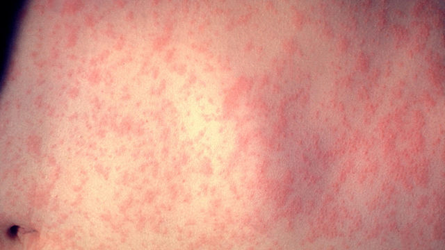 Measles case confirmed in metro Atlanta; it's the 8th case this year in Georgia - WSB Atlanta thumbnail